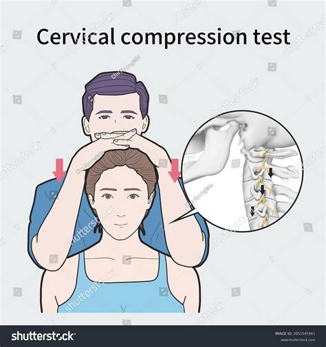 cervical compression test vs spurling& 39|axial cervical compression test.